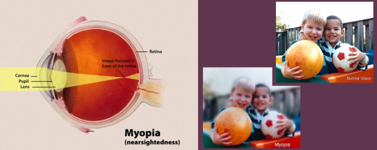 Collage of images from Wikipedia showing how the image is in front of the retina and an example of blurriness. Click the image to go to the source.